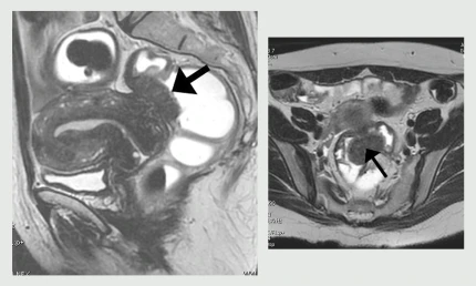 Endometriosi art